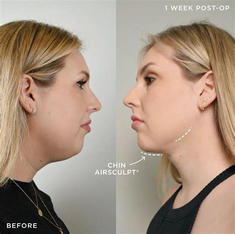 airsculpt reviews|airsculpt stomach before and after.